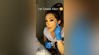 1st Cheek filler [upl. by Jean-Claude]