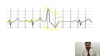 Mastering ECGLesson17 PVCs amp PACs  premature ventricular amp atrial contractions [upl. by Helyn665]