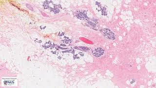 Breast Fibrocystic change microscopy  Talking slide [upl. by Ruder59]