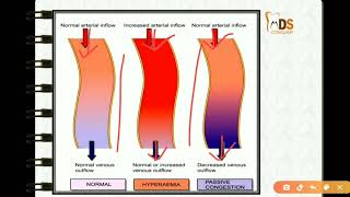 Haemodynamics  Hyperaemia amp Congestion [upl. by Fergus]