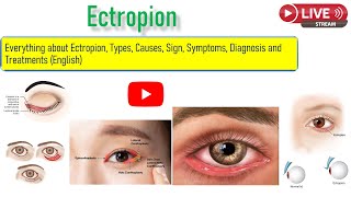 Everything about ectropion Types Sign Symptoms and Treatment option including surgury [upl. by Peggir]