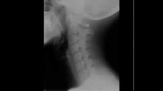 Cervical Spine Radiology Tutorial [upl. by Aisanahta]