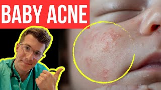 Doctor explains BABY ACNE aka NEONATAL ACNE  Symptoms photos treatment amp more [upl. by Etirugram889]