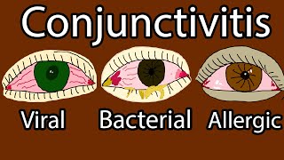 Pink Eye Conjunctivitis  Viral Bacterial and allergic conjunctivitis Symptoms and treatment [upl. by Eldoria]