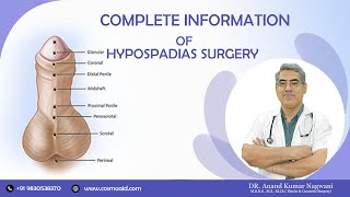 Hypospadias Surgery  Complete Information of Hypospadias Problem amp Solution  By Dr A K Nagwani [upl. by Obie718]