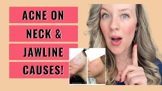 Acne on neck and jawline  ACNE ON JAWLINE CAUSES [upl. by Saloma]