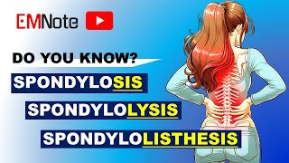 Spondylosis Spondylolysis and Spondylolisthesis [upl. by Atteroc]