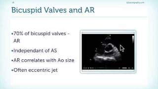 Causes of Aortic Regurgitation [upl. by Kendrah]