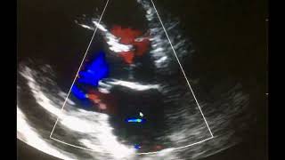 Ecocardiograma Complicaciones del Infarto al miocardio [upl. by Adigun]