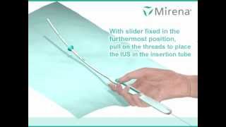 Mirena IUS insertion procedure animated [upl. by Hasan]