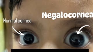 Normal corneal Diameter VS Megalocorneal Diameter  Optometry Solutions [upl. by Rosa]