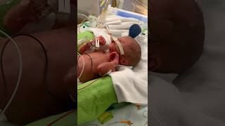 Miracle baby survives at 27 weeks shorts [upl. by Assili322]