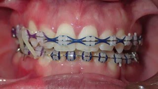 Orthodontic Transformation from Start to Finish [upl. by Anitaf]