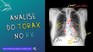 Aprenda a analisar o exame de TÓRAX no RX [upl. by Sibella]