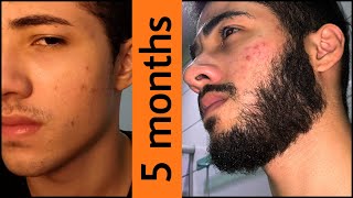 Minoxidil Beard Journey 5 MONTHS TRANSFORMATION [upl. by Enohpesrep]