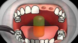 Dental Alveolitis [upl. by Jessamyn]