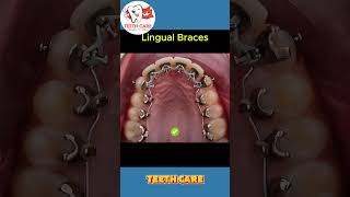 braces transformation teeth braces dental dentalcare dentalhealth dentalimplants shorts [upl. by Nelram]