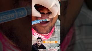 Dental filling procedure  teeth veneer  viral dentist [upl. by Ranjiv]