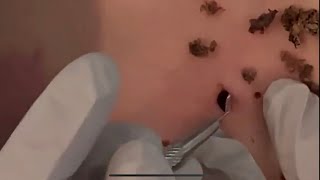 Top Biggest Blackhead on the world 21 [upl. by Luar320]