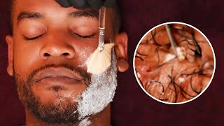 EXTREME Beard Care with SATISFYING Ingrown Hair removal [upl. by Ishii]