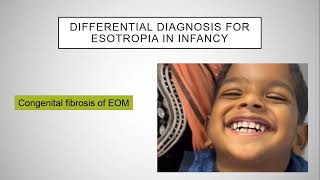 Esotropia Enigma Understanding and Managing Childhood Strabismus [upl. by Balmuth283]