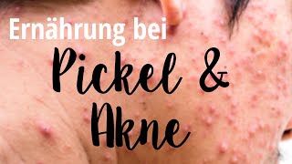 5 Ernährungstipps bei Pickel und Akne  Satte Sache  Ernährungsmedizin amp Wissenschaft [upl. by Brittany]