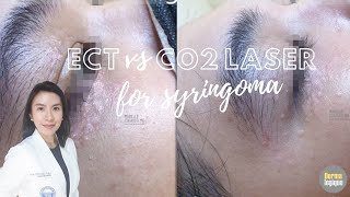 Syringoma Removal Electrocautery vs CO2 Laser [upl. by Atival848]