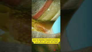 How To Properly Remove Ear Wax كَيْفِيَّةُ إِزَالَةِ شَمْعِ الأُذُنِ بِشَكْلٍ صَحِيحٍ ؟ [upl. by Etty]