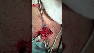 Femoral Hernia Repair Lotheissens operation inguinal approach [upl. by Ynar]