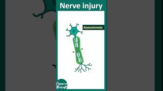 Types of nerve injury  neuropraxia  axonotmesis  neurotmesis  Wallerian degeneration  USMLE [upl. by Botti679]