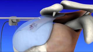 Shoulder Arthroscopy [upl. by Notsur]