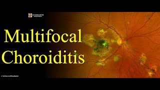 Multifocal Choroiditis [upl. by Haines]