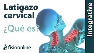 Latigazo cervical  ¿Qué es y cuáles son las claves de su solución [upl. by Hueston]