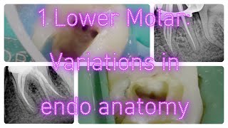 Most important variations in 1 Mandibular molar ENDODONTIC ANATOMY [upl. by Silera]