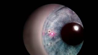 Laser Peripheral Iridotomy with a Model Eye [upl. by Annayt]