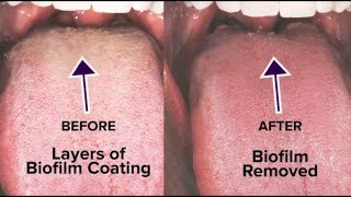 Tongue Rejuvenation The ANSWER to Fixing Chronic Bad Breath amp Halitosis [upl. by Pattin222]