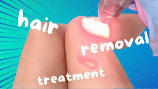 LASER HAIR REMOVAL TREATMENT  ALEXANDRITE LASER THIGH [upl. by Pegeen615]