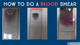 How to Prepare a Peripheral Blood Smear Hematopathology amp Hematology with Dr Jeanette Ramos [upl. by Aissat]