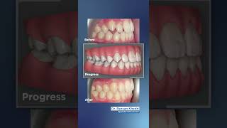 Presenting the art of orthodontics using Invisalign for teenagers [upl. by Nedgo]