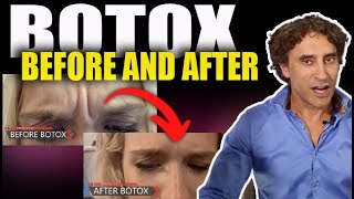 BOTOX BEFORE and AFTER  Botox Injections [upl. by Ennirak347]