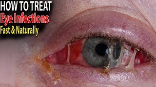 EYE INFECTIONS  5 Home Remedies to Treat Eye Infections Fast amp Naturally [upl. by Nosittam]