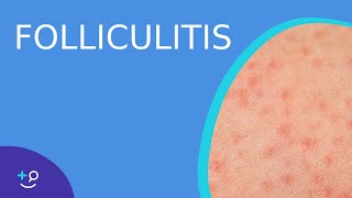 Folliculitis  Daily Dos of Dermatology [upl. by Cristian]