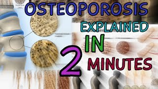 OSTEOPOROSIS  EXPLAINED IN 2 MINUTES  CAUSES  SYMPTOMS  TREATMENT  WHAT IS OSTEOPOROSIS [upl. by Eentruok]