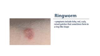 Skin Infections Ringworm [upl. by Aicissej]