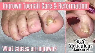 How to Pedicure Foot Care Tips on an Ingrown Toenail [upl. by Devonna]