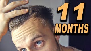 FUE Hair Transplant 11 Months post OP Istanbul Turkey [upl. by Ezri784]