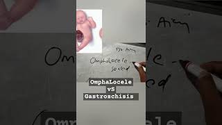 OmphaLocele vs gastroschisis shorts ytshorts fmgeians neetpg medicine [upl. by Utley]