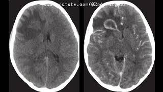 Case 58 Axial views from a CT scan of the brain [upl. by Frazer]