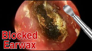 BIGGEST Ear Wax Difficult Removal  EP5  Doctor Anh [upl. by Graner]