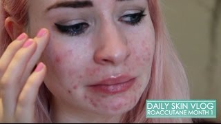 Roaccutane Daily Skin Vlog  Month 1 [upl. by Girish]